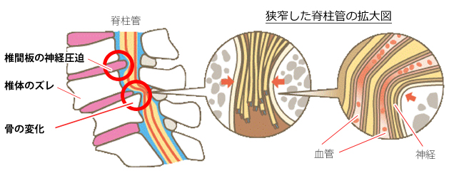 は 狭窄 症 脊柱 管 と